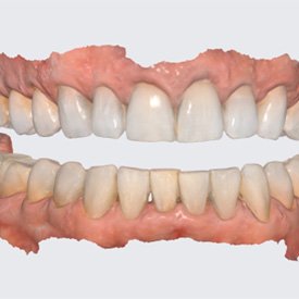 Digital scan of patients upper and lower teeth against neutral background