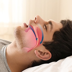 Sleeping man with airway animation on profile